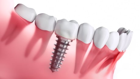 Implantes dentales en Mataró