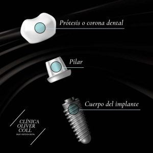 partes-de-un-implante-dental