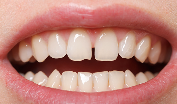 Un paciente presenta sus dientes separados al sufrir diastema dental.