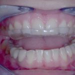 Detalles del adjunto Ferula-descarga-para-tratamiento-bruxismo-nocturno-scaled.jpeg 27 de agosto de 2025 398 KB 2560 por 1696 píxeles Imagen original: Ferula-descarga-para-tratamiento-bruxismo-nocturno.jpeg Editar la imagen Borrar permanentemente WP Rocket recommends you to optimize your images for even better website performance. Install Imagify Plugin Texto alternativo Aprende cómo describir el propósito de la imagen(abre en una nueva pestaña). Déjalo vacío si la imagen es puramente decorativa.Título Férula descarga para tratamiento bruxismo nocturno Leyenda Descripción URL del archivo: https://clinicadentalolivercoll.com/wp-content/uploads/2022/12/Ferula-descarga-para-tratamiento-bruxismo-nocturno-scaled.jpeg Copiar la URL al portapapeles Smush 8 imágenes reducidas en 238,4 KB (9.7%) Tamaño de la imagen principal: 368,31 KB Ver estadíticas Los campos obligatorios están marcados con * Sustituir medios Subir nuevo archivo Para reemplazar el archivo actual haz clic en el enlace y sube un archivo de reemplazo. Eliminar fondo Eliminar fondo Para eliminar el fondo haz clic en el enlace. Ajustes de visualización de adjuntos Alineación Centrar Enlazado a Ninguna Tamaño Miniatura – 150 × 150 Acciones de los medios seleccionados 1 elemento seleccionado Borrar Insertar en la entrada Ningún archivo seleccionado