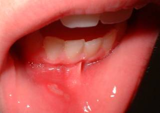 estomatitis aftosa