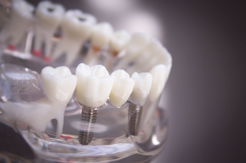 implantes