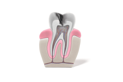 reendodoncia