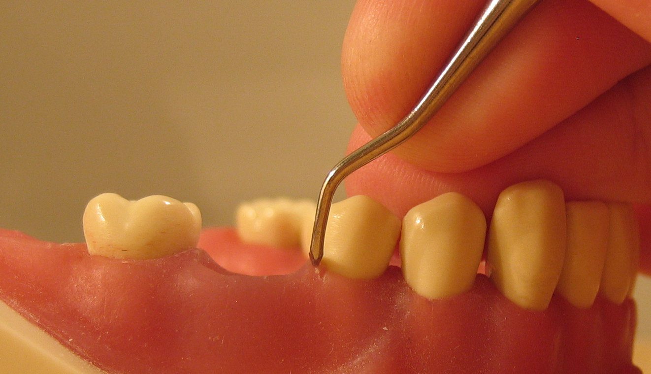 Periodontitis en Oliver Coll