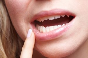 Periodontitis: tratamiento