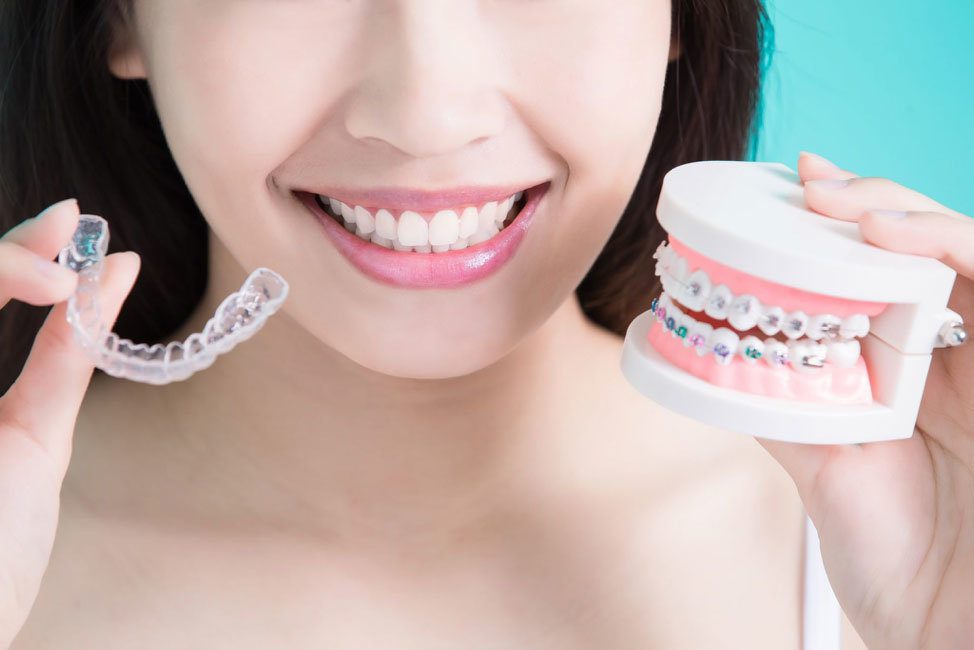 Diferencias entre ortodoncia invisible y brackets