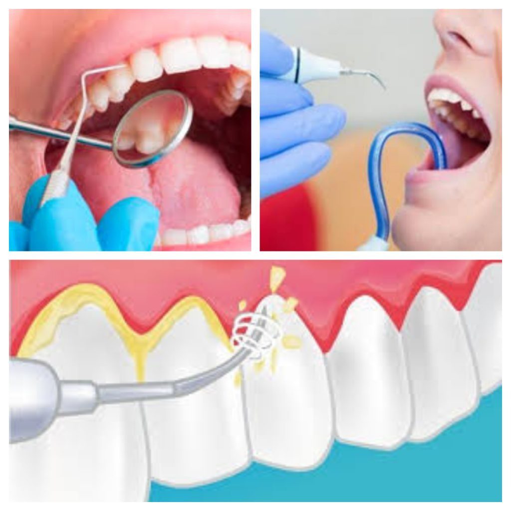 Limpieza dental en Mataróo