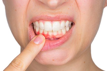 Sonrisa con recesión de encías.