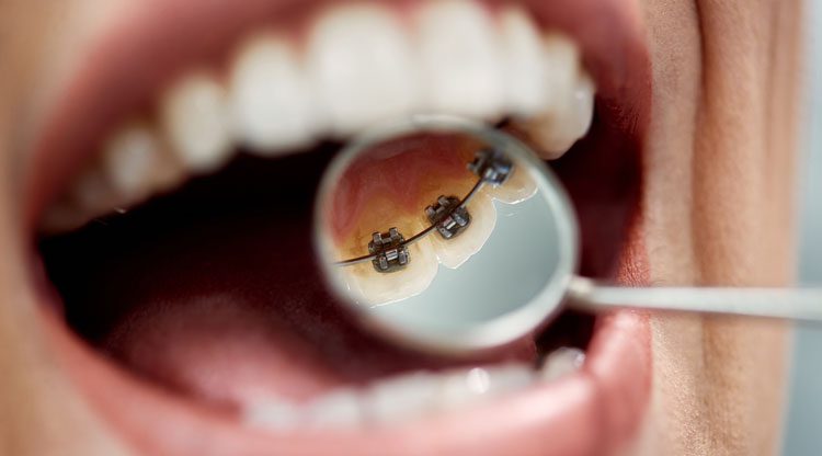 tratamiento-ortodoncia-lingual-mataro