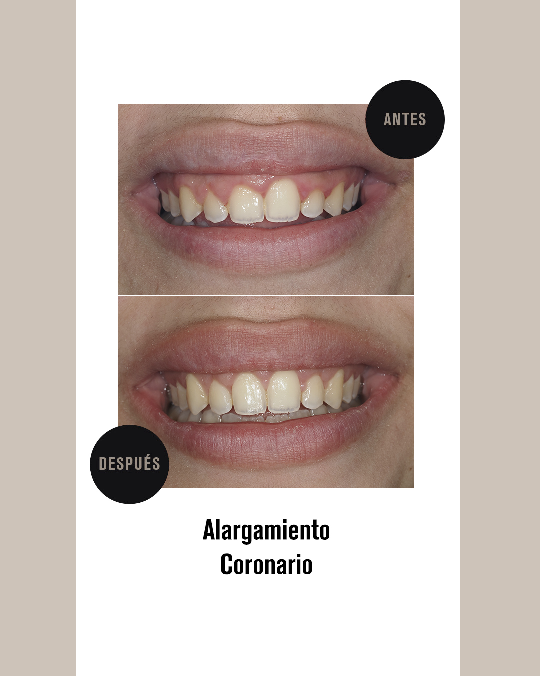 ALARGAMIENTO CORONARIO