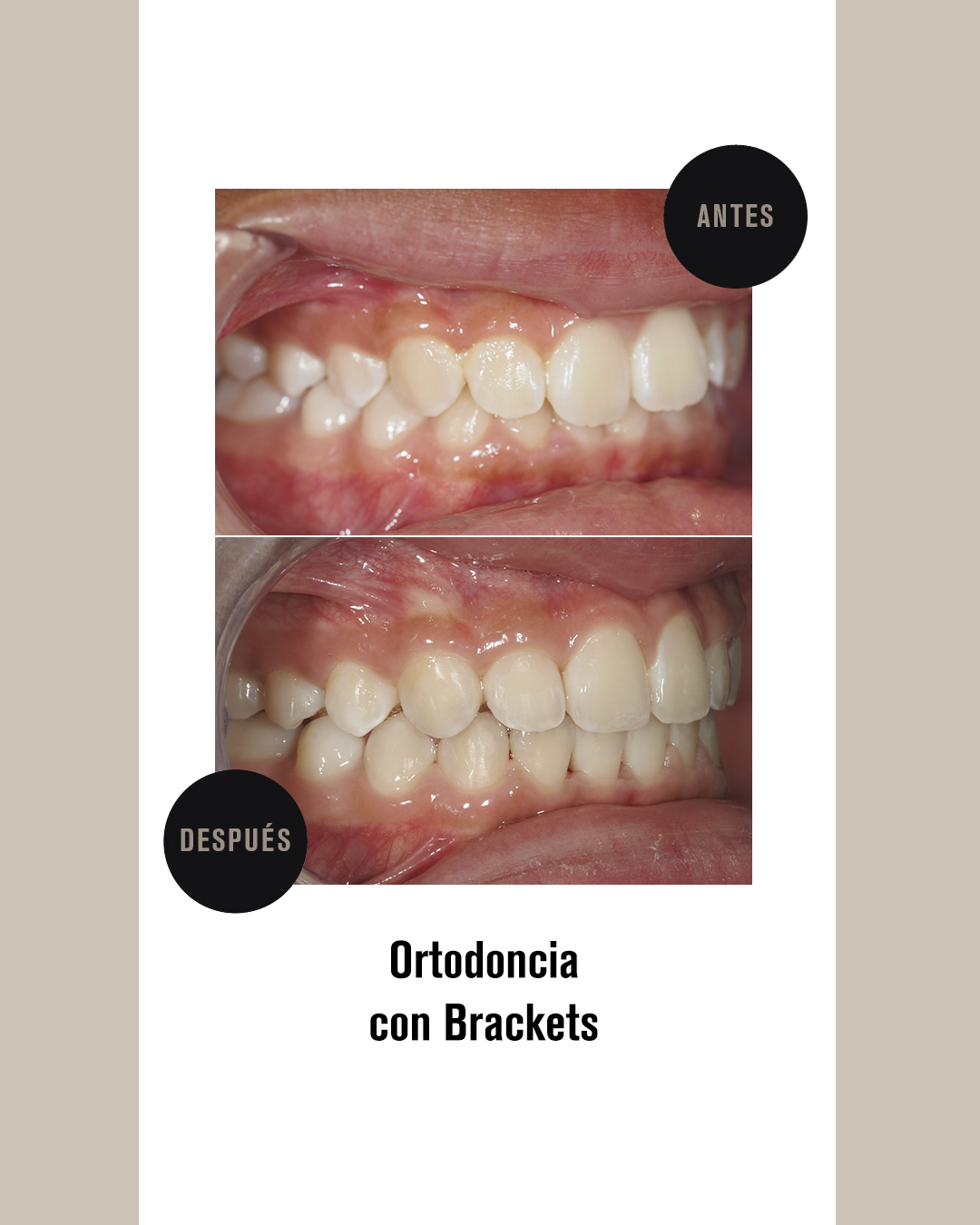 BRACKETS (2)