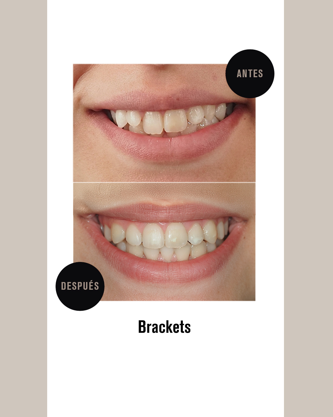 BRACKETS (3)