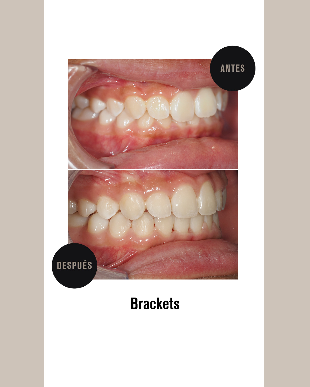 BRACKETS 4