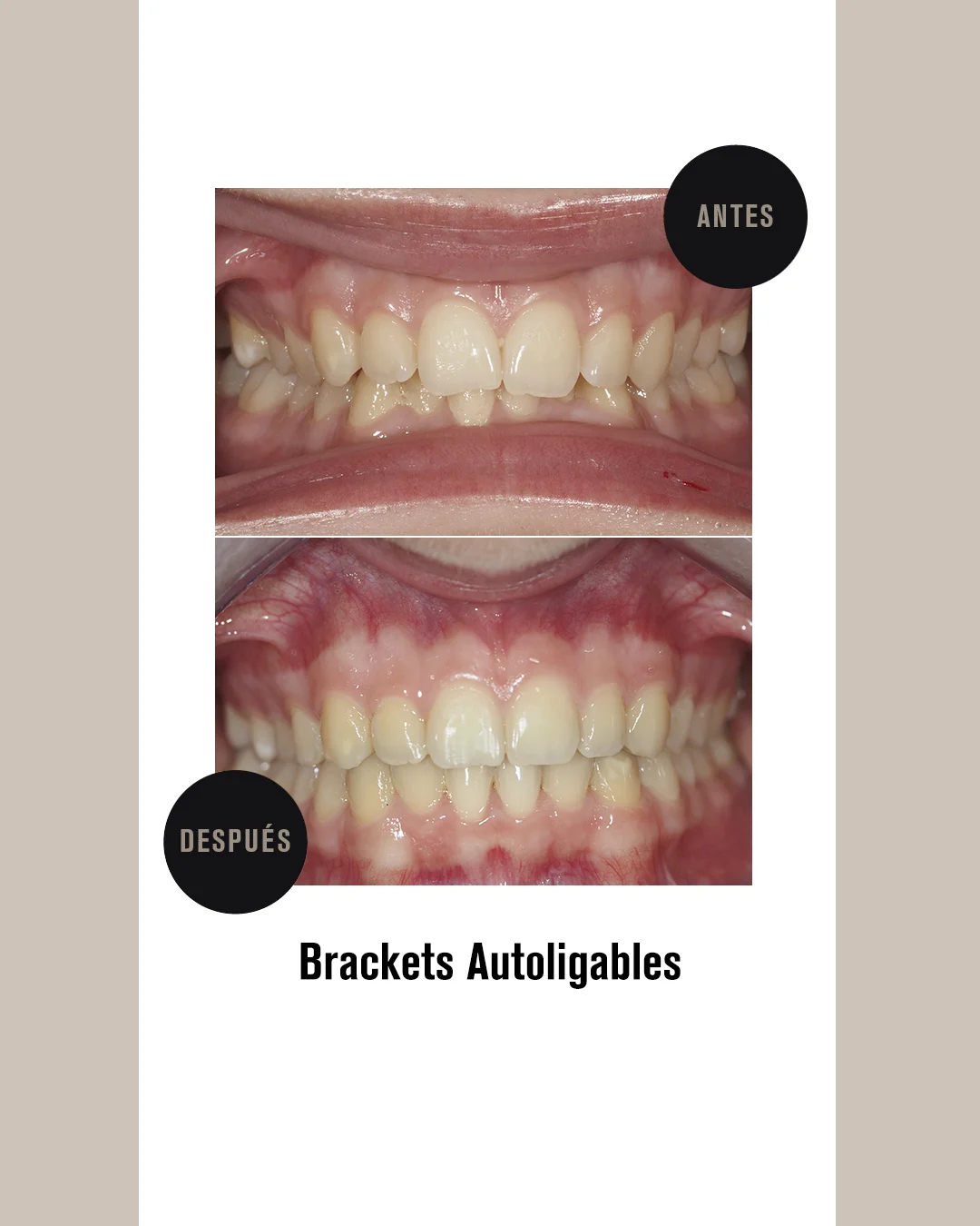 BRACKETS AUTOLIGABLES