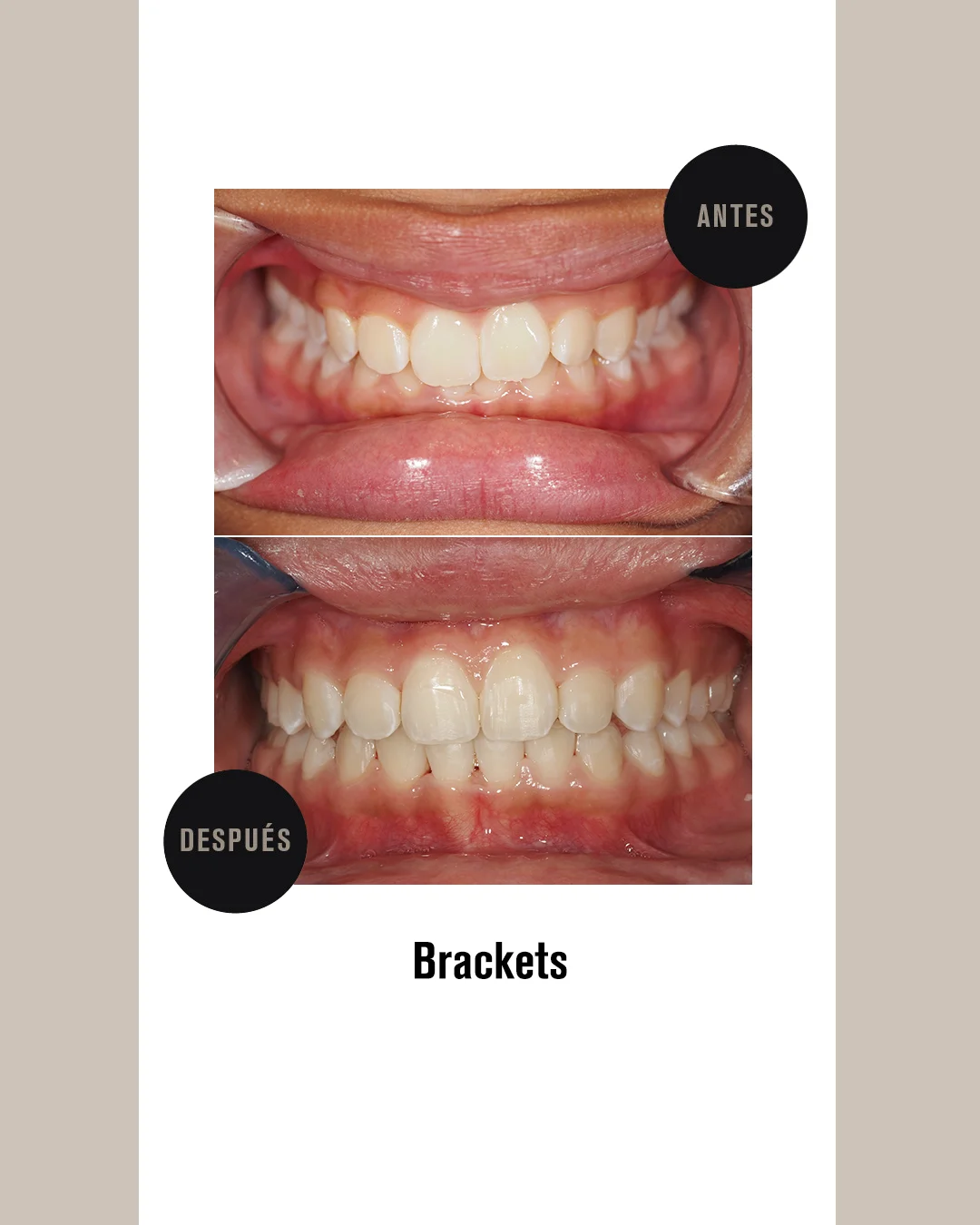 BRAKETS 3