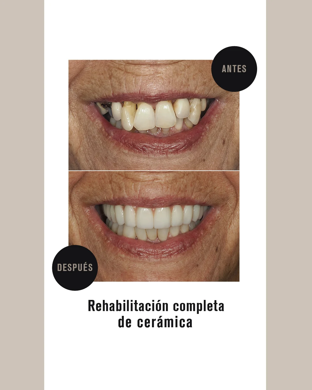 IMPLANTS DENTALS (2)