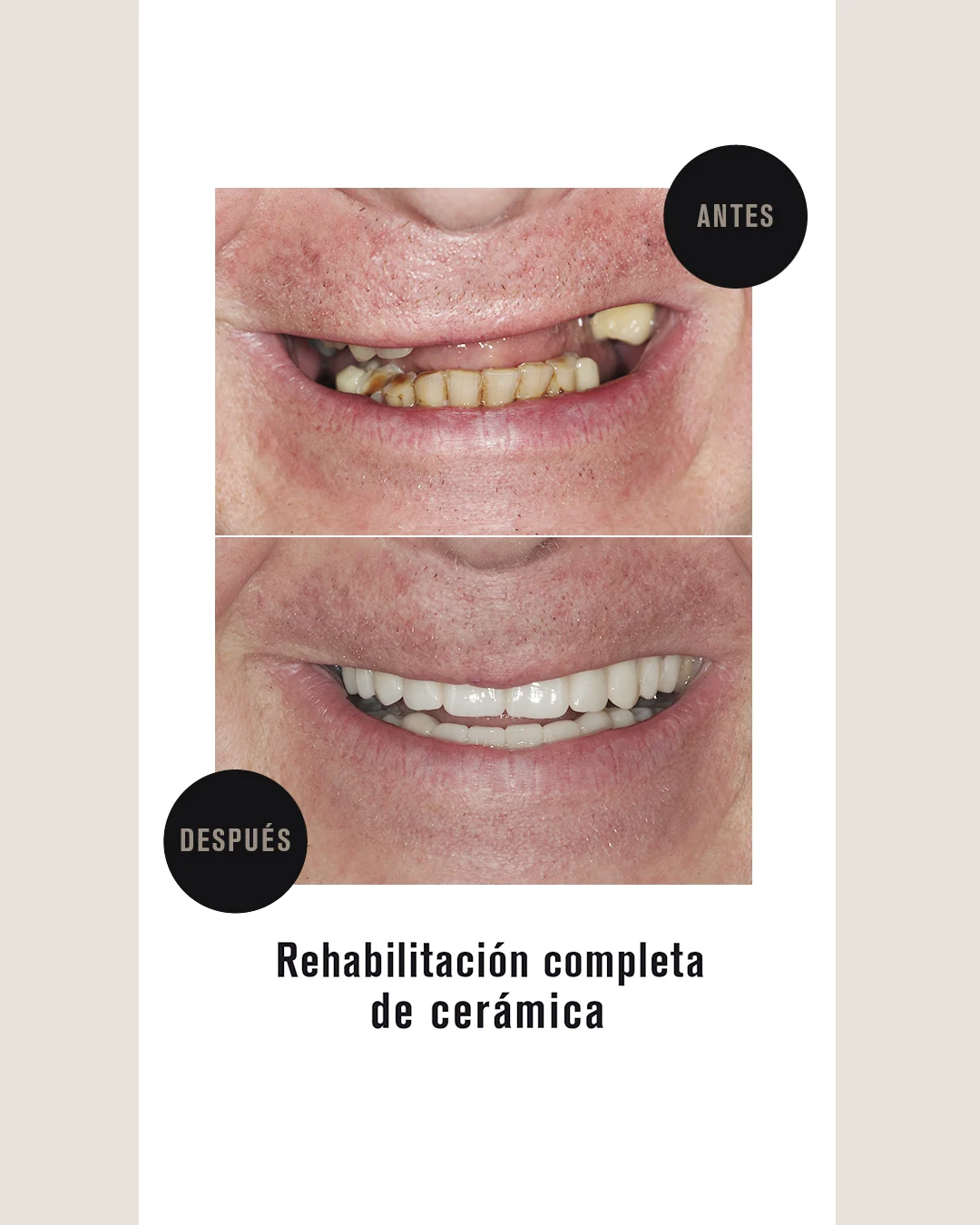 IMPLANTS DENTALS