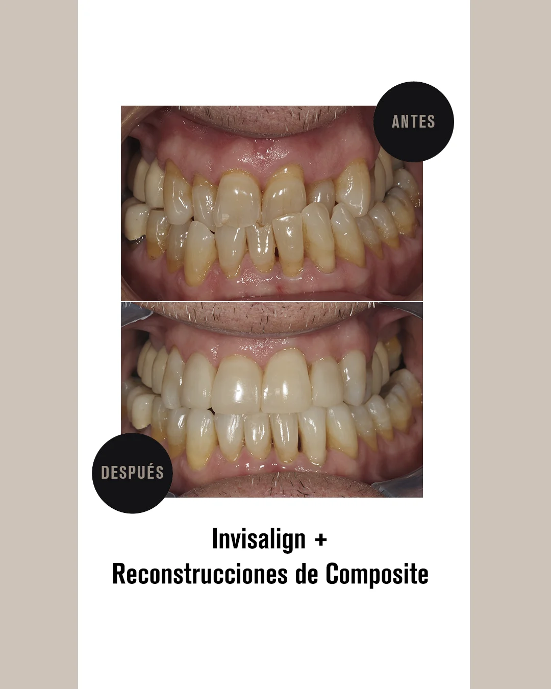 RECONSTRUCCIONES COMPOSITE