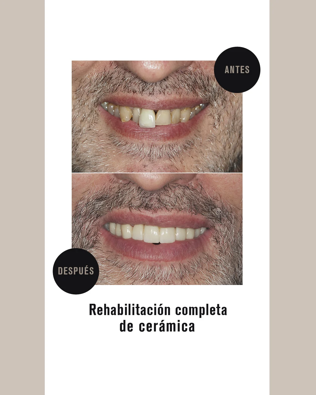 CORONAS CERAMICA (3)