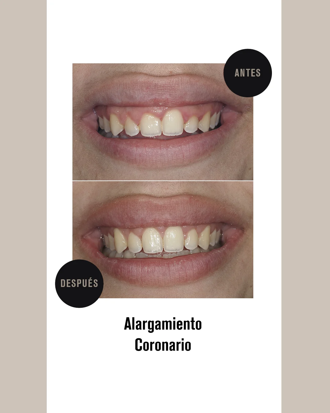 ALARGAMIENTO CORONARIO