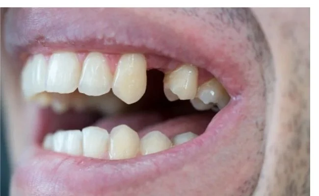 deplazamiento dental por falta de pieza